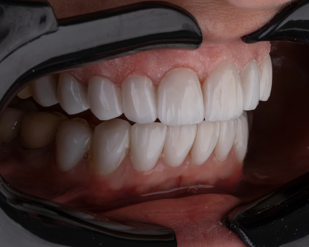 Purple Braces: The Bold and Vibrant Choice for Orthodontic Treatment